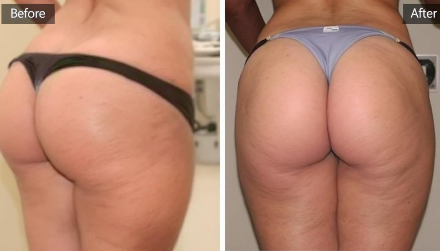 Améliorer le galbe fessier : avantages d'une combinaison liposuccion et lipofilling ?
